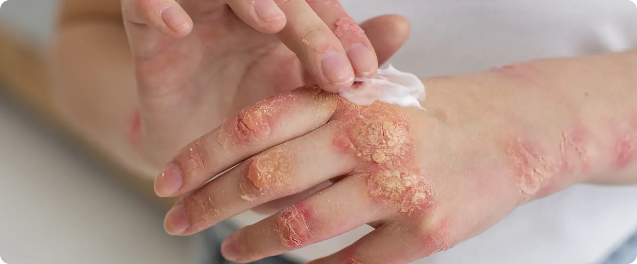 Síntomas de la fiebre del mono | Síntomas del herpes zóster