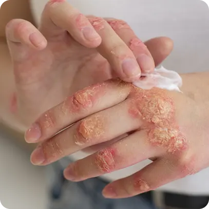 Síntomas de la fiebre del mono | Síntomas del herpes zóster Síntomas de la fiebre del mono | Síntomas del herpes zóster