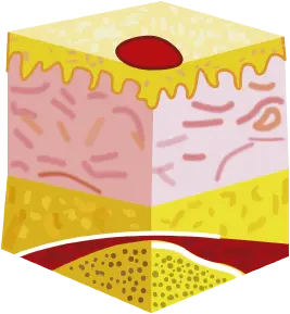 Estadio I: Eritema no blanqueante