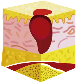 Estadio III: Pérdida total del grosor de la piel